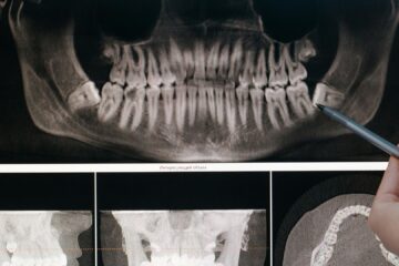 Bölcsességfog műtét a MyDent fogászat budapesti rendelőjében
