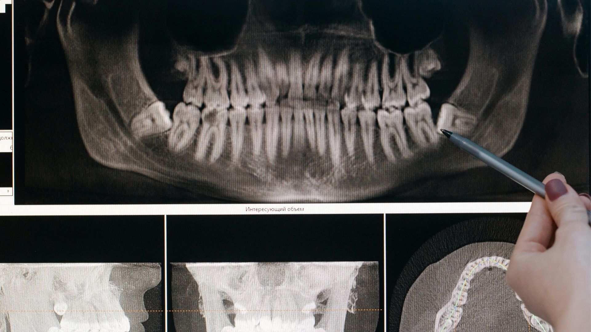 Bölcsességfog műtét a MyDent fogászat budapesti rendelőjében